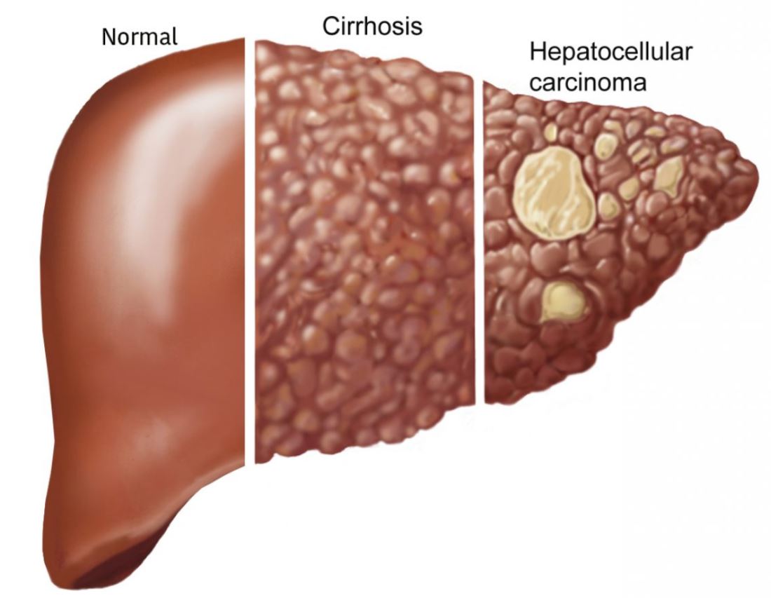 CAN LIVER CANCER BE PREVENTED?